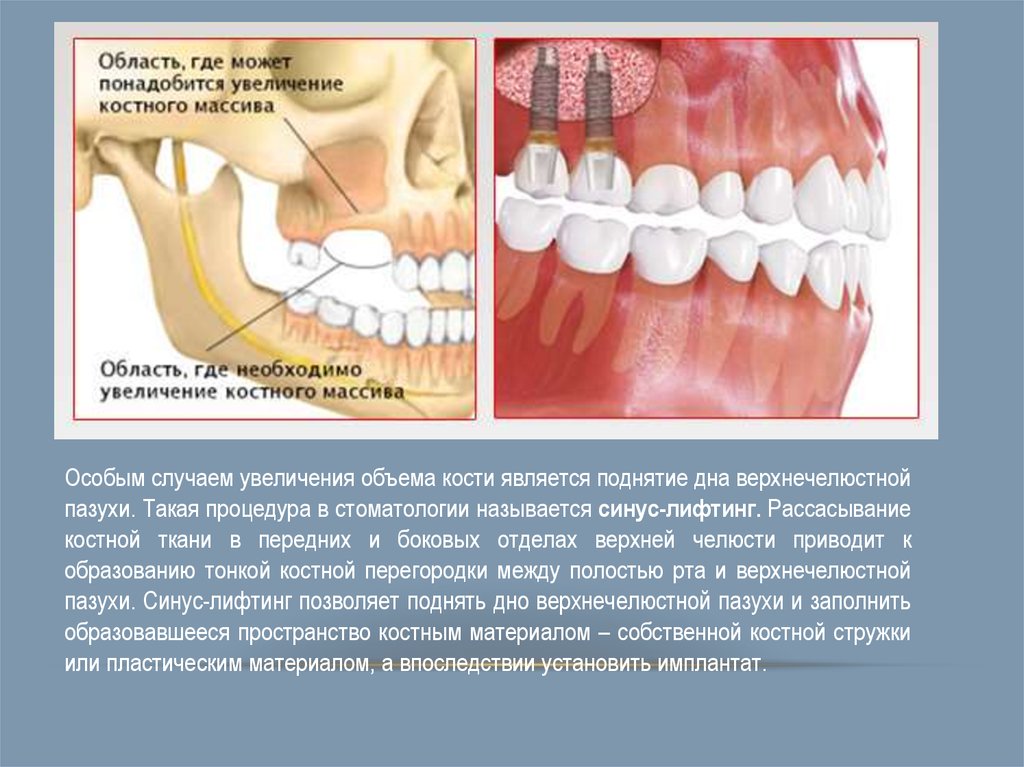 Увеличение случай. Рассасывание костной ткани челюстей. Верхнечелюстной синус. Костная челюстная ткань. Зубная кость рассасывается.
