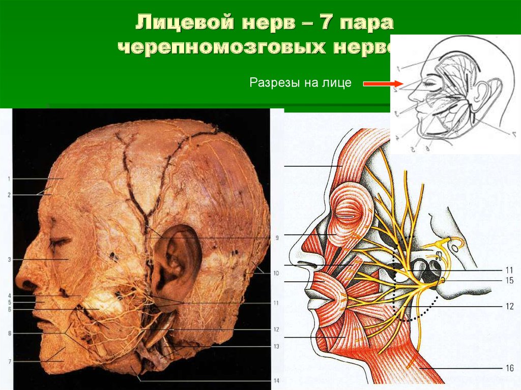 Волокна лицевого нерва. Лицевой нерв ЧМН. Лицевой нерв 7 пара ЧМН. Лицевой нерв анатомия топография схема. Расположение ветвей лицевого нерва.