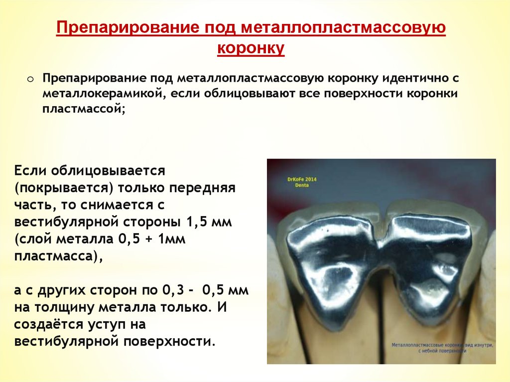 Изготовление металлопластмассовой коронки