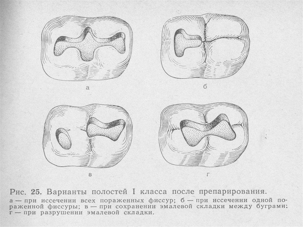 Препарирование кариозных полостей по классам. Кариозная полость 1 класса по Блэку. Препарирование 1 класса по Блэку. Отпрепарированные полости по 1 классу по Блэку. Препарирование кариозных полостей 1-5 класса.