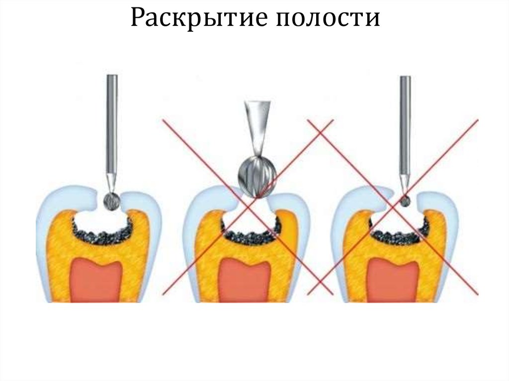 Края кариозной полости. Этапы препарирования раскрытие полости. Боры для препарирования кариозных полостей по 1 классу. Этапы препарирования кариозных полостей 1. Ручные боры для препаровки кариозной полости.