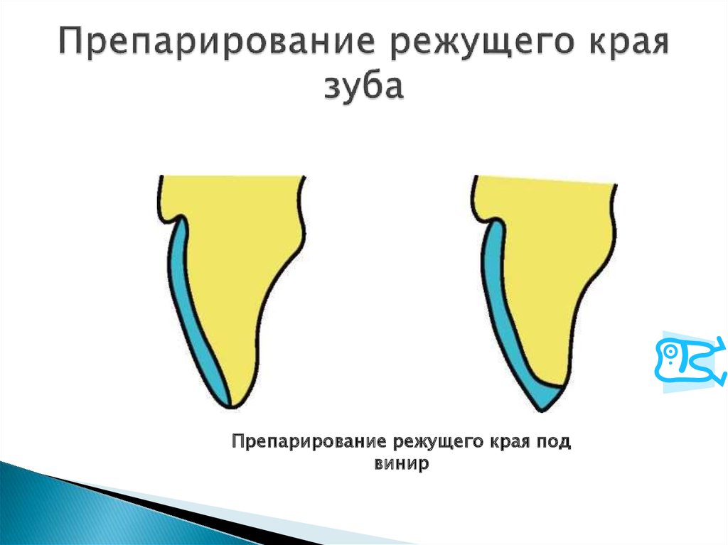 Препарирование под металлическую коронку схема