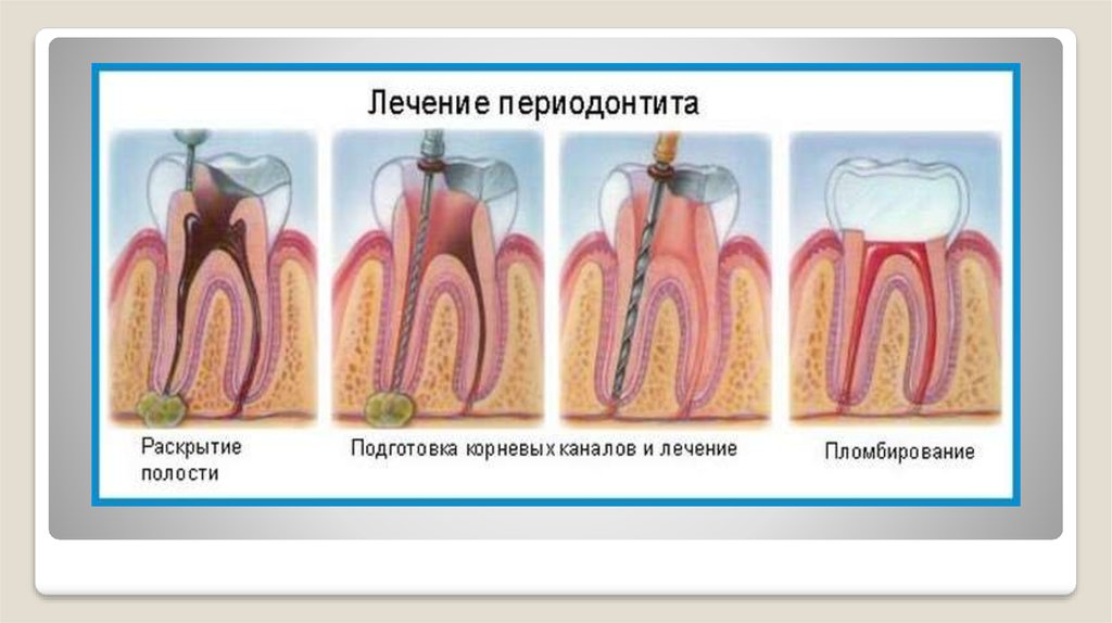 Периодонтит лечение. Схема лечения периодонтита в стоматологии. Материалы для лечения периодонтита.