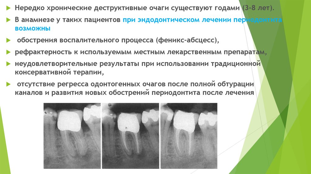 Принципы лечения периодонтита