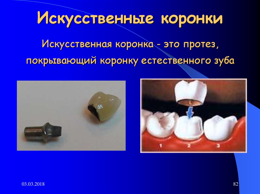 Какую функцию выполняет коронка зуба. Искусственные коронки. Искусственная коронка зуба. Искусственные коронки презентация. Классификация искусственных коронок.