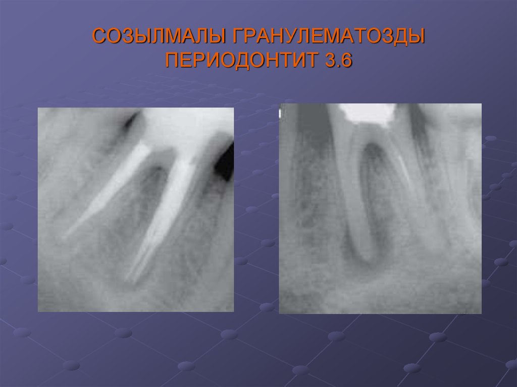 Лечение периодонтита зуба. Хронический Гнойный периодонтит. Острый Гнойный периодонтит. Периодонтит 3-х канальный * — 7500 р..