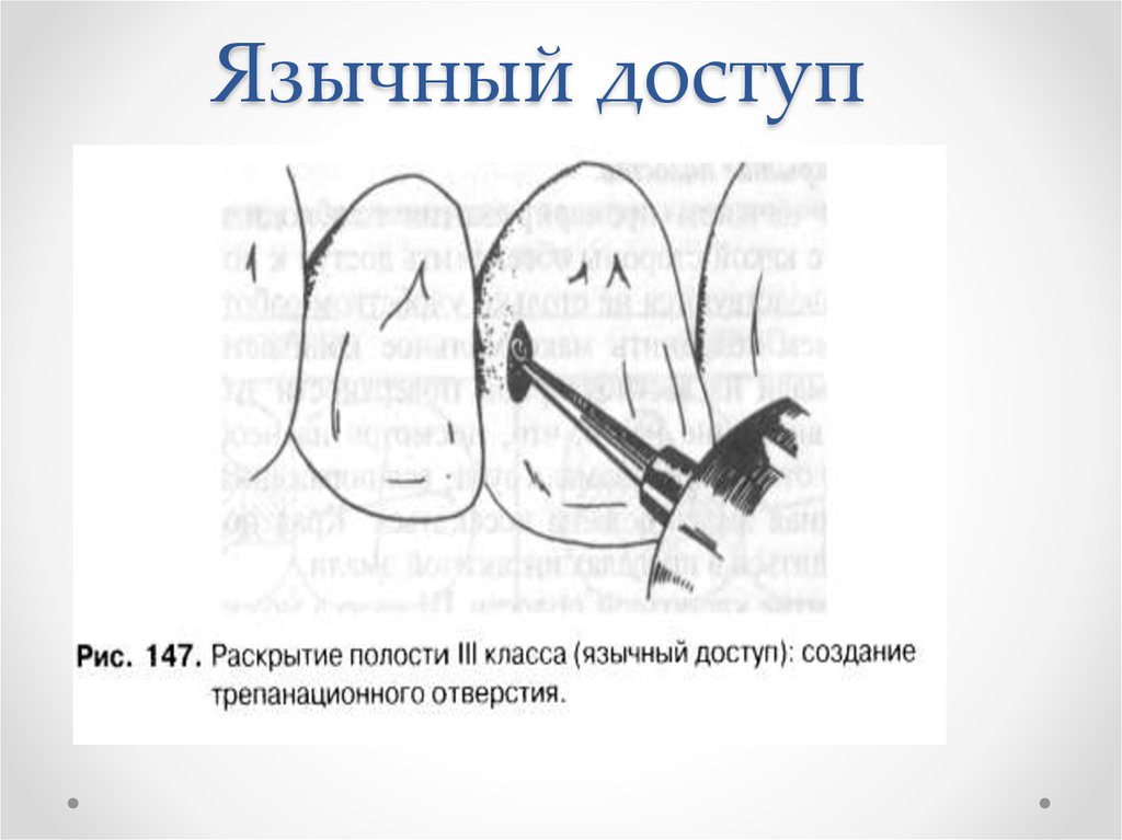 Тест блэка. Виды доступа к полости III класса. Полости 2 класса прямой доступ.