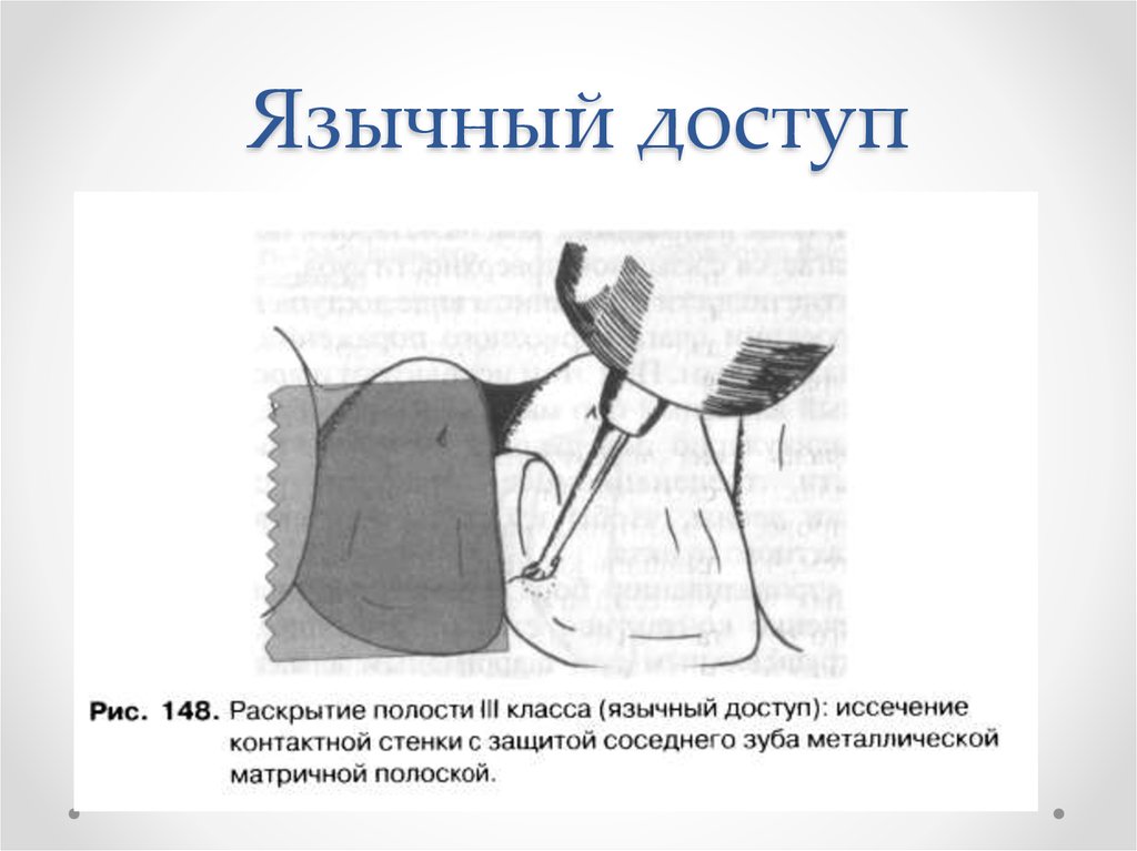 3 полости. Препарирование раскрытие полости. Раскрытие кариозной полости 3 класса язычный доступ. Раскрытие полости 3 класса язычный доступ. Раскрытие полости 4 класса по Блэку.