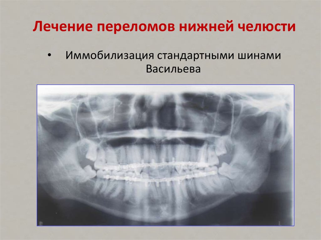 Места переломов нижней челюсти