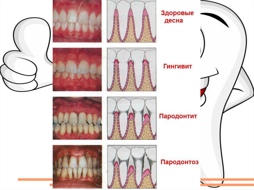 Состояние пародонта