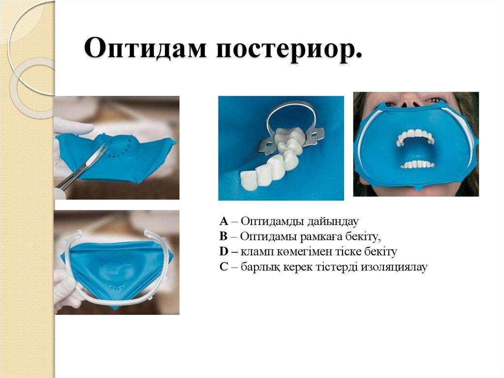 Оптидам. Оптидам Постериор в стоматологии. Оптидам Антериор и Постериор. Оптидам и коффердам отличия.