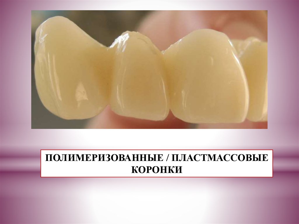 Какие бывают коронки. Комбинированные искусственные коронки. Пластмассовые коронки презентация. Искусственные коронки презентация.