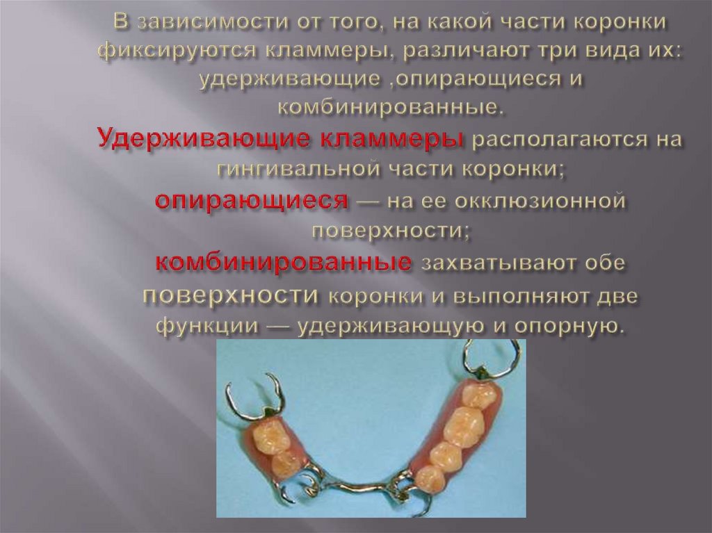 Дробители нагрузки бюгельного протеза. Классификация кламмеров бюгельного протеза. Функция кламмера.