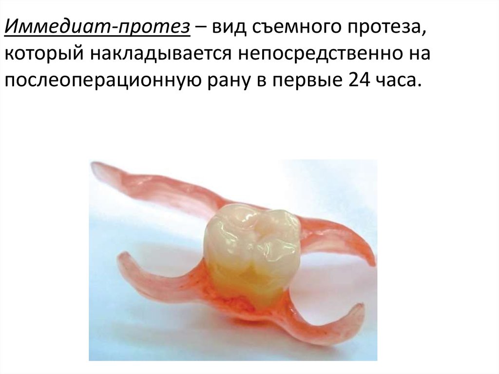 Этапы изготовления иммедиат протеза. Несъемные иммедиат-протезы.