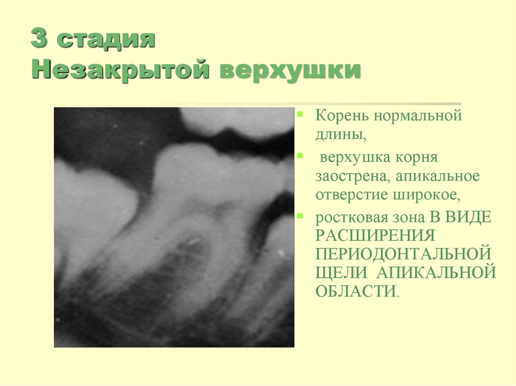 Верхушка корня. Стадия незакрытой верхушки корня. Этапы формирования корней. Стадии формирования корней постоянных зубов. Стадии формирования верхушки корня зуба.