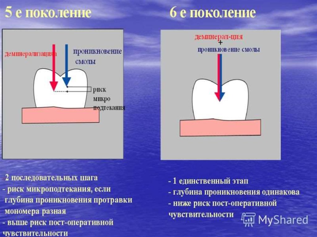 Шарнир в стоматологии это