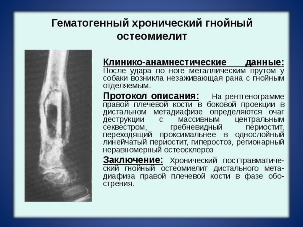 Гематогенный остеомиелит