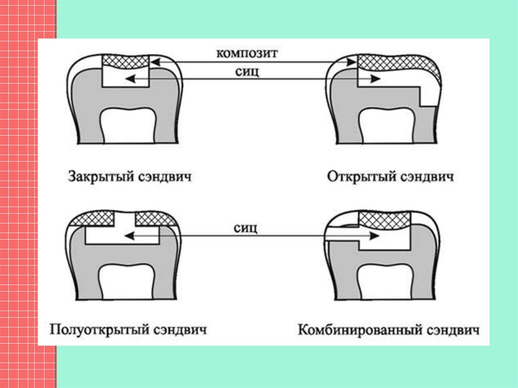 Пломбирование кариозных полостей временных. Изолирующая прокладка СИЦ. Закрытый сэндвич изолирующая прокладка. Наложение пломбы из композиционного материала.