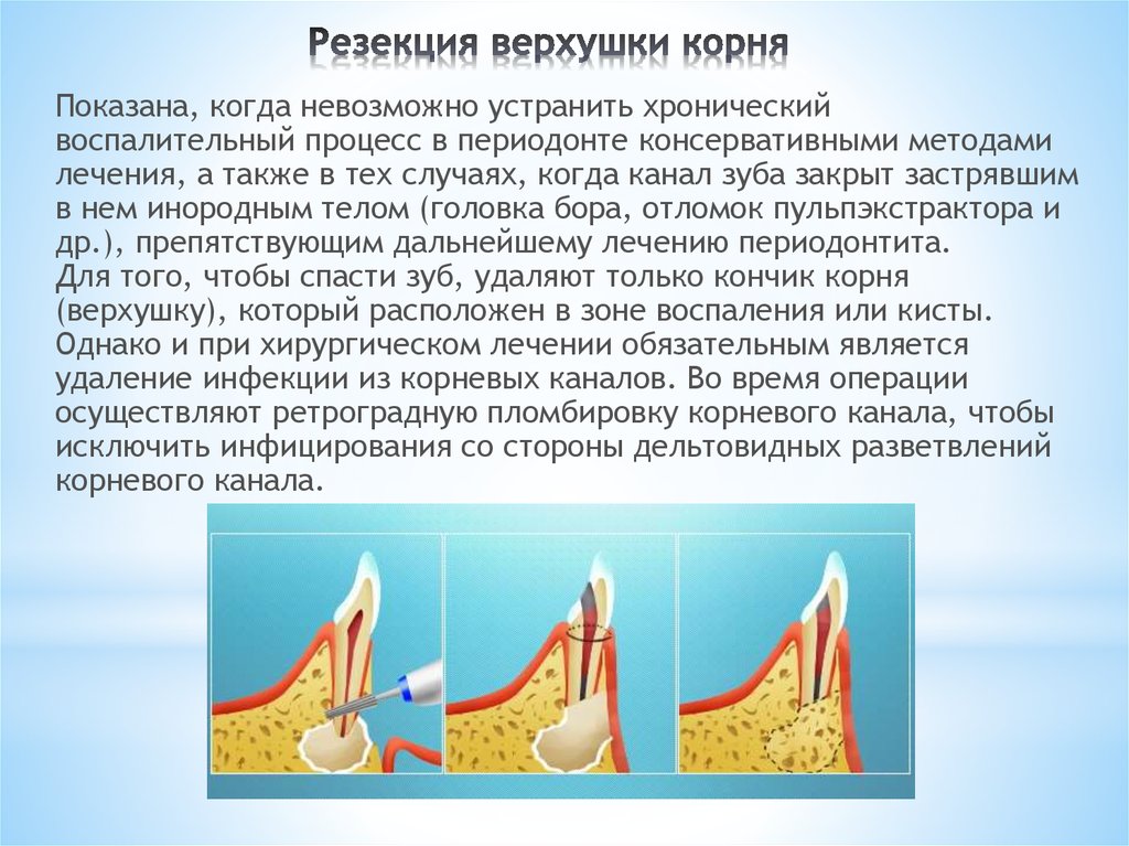 Цистоэктомия. Резекция верхушки корня зуба. Показания к проведению операции резекция верхушки корня. Резекция верхушки корня методика.