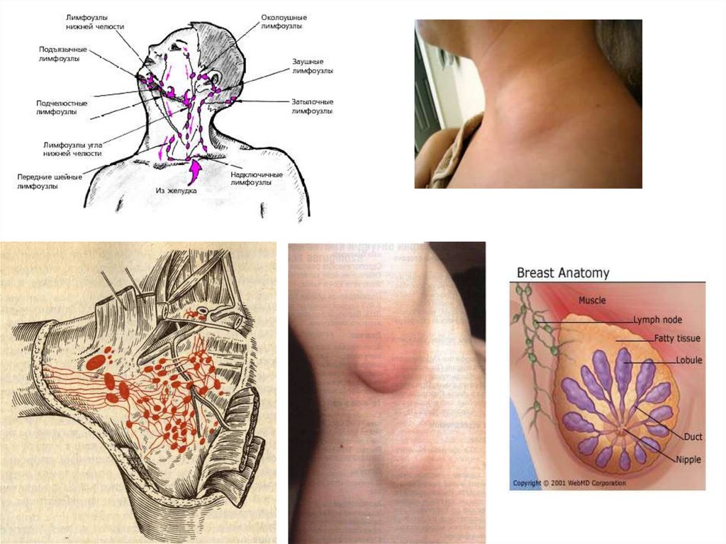 Как воспаляются лимфоузлы на шее расположение схема