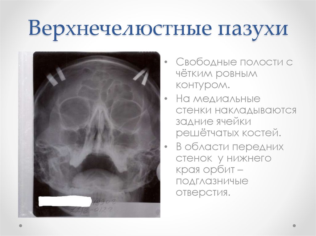 Правая верхнечелюстная пазуха где находится картинка