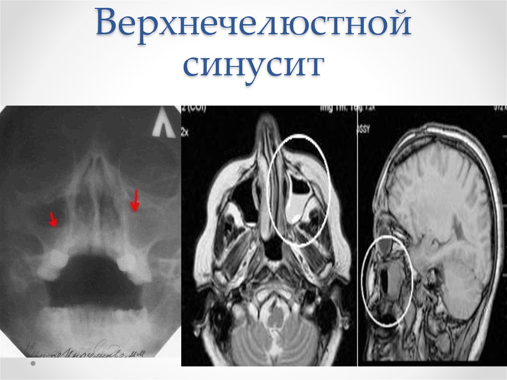 Одонтогенный синусит презентация