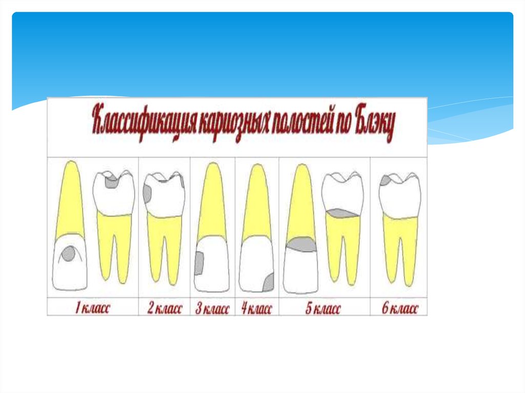 Классы по блэку. Препарирование по Блэку. Классы препарирования по Блэку. Классификация по Блеку. Классификация препарирования по Блэку.