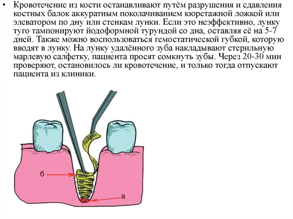 Положил лекарство в лунку. Лунка после удаленного зуба. Лунка удаленного зуба мудрости. Тампонада лунки удаленного зуба. Что накладывать на зуб после удаления.