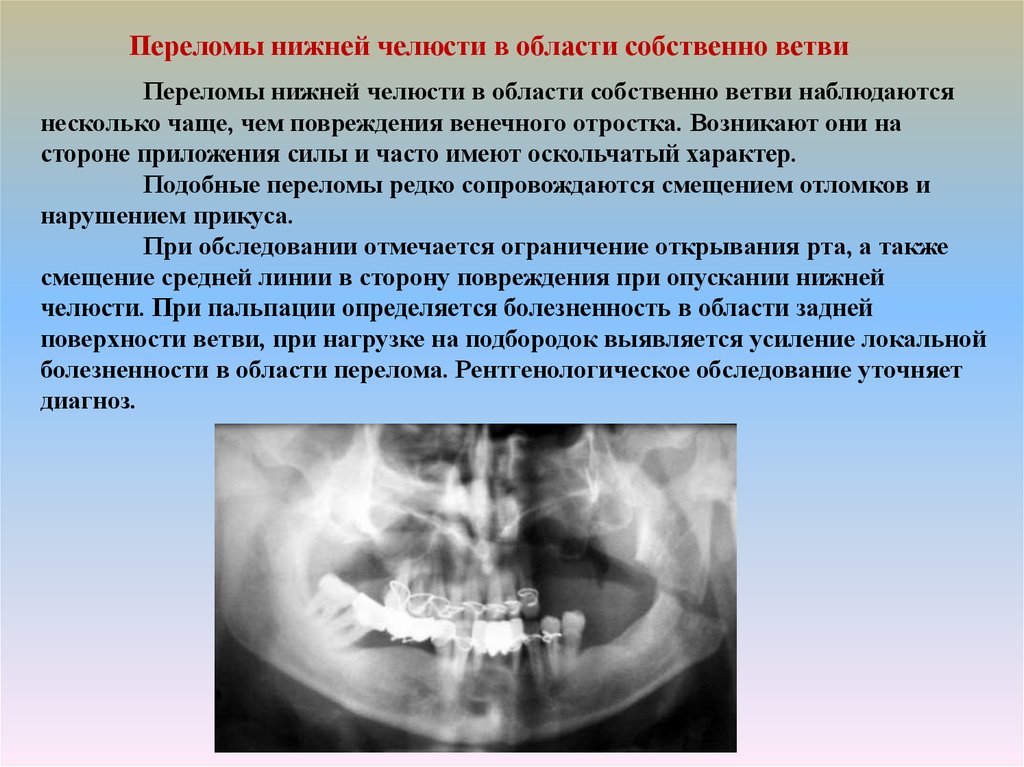 Перелом нижней челюсти. Перелом ветви нижней челюсти. Огнестрельные переломы нижней челюсти презентация. Перелом собственно ветви нижней челюсти. Диагноз перелома ветви нижней челюсти.