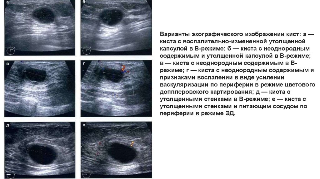 Кисты молочных желез могут рассосаться