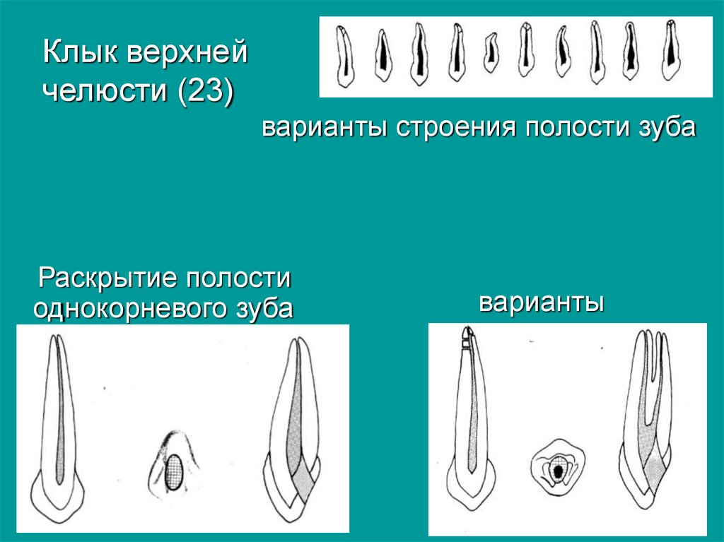 Верхний клык. Топография полости зуба. Верхний клык анатомия. Анатомо-топографические особенности полости зуба.