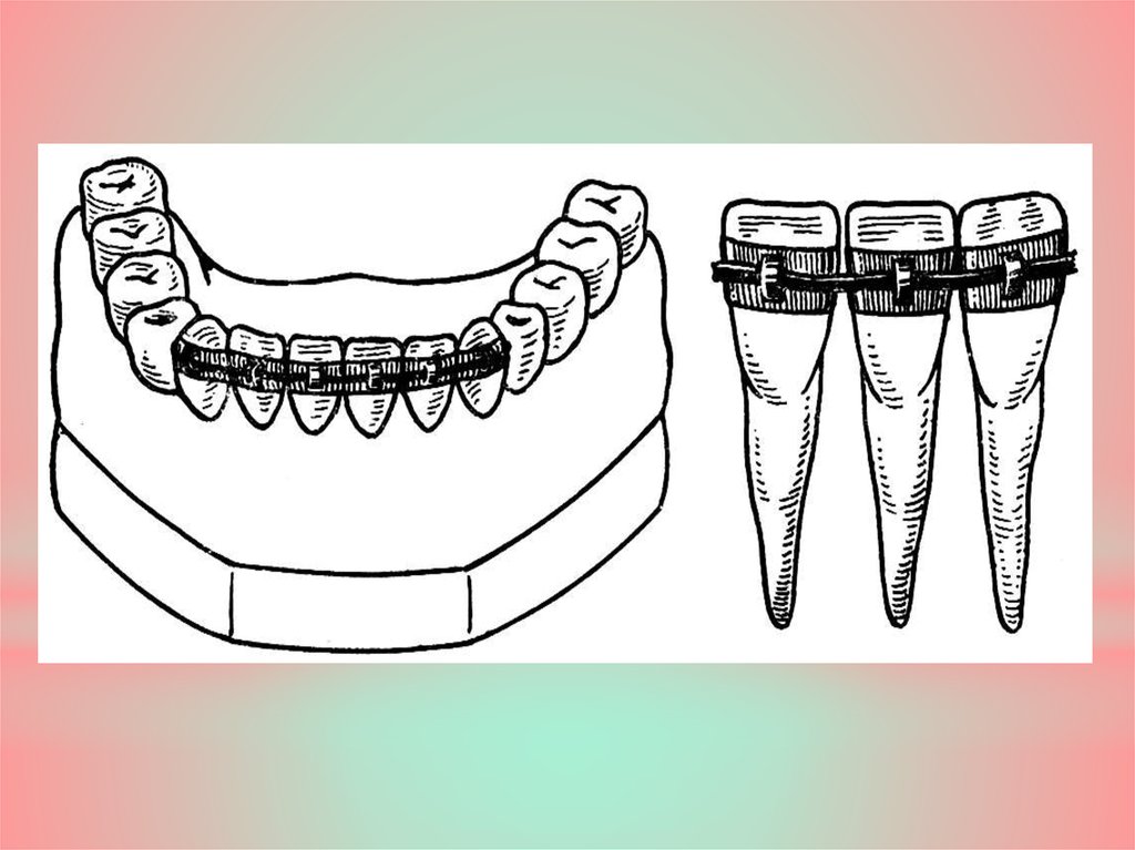 Шинирование зубов при ортопедическом лечении заболеваний пародонта презентация