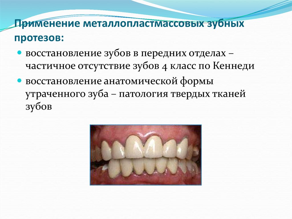 Восстанавливающий вид. Конспект про зубов. Частичное отсутствие зубов, причины развития.. Осложнения частичного отсутствия зубов. Частичное отсутствие зубов классы.