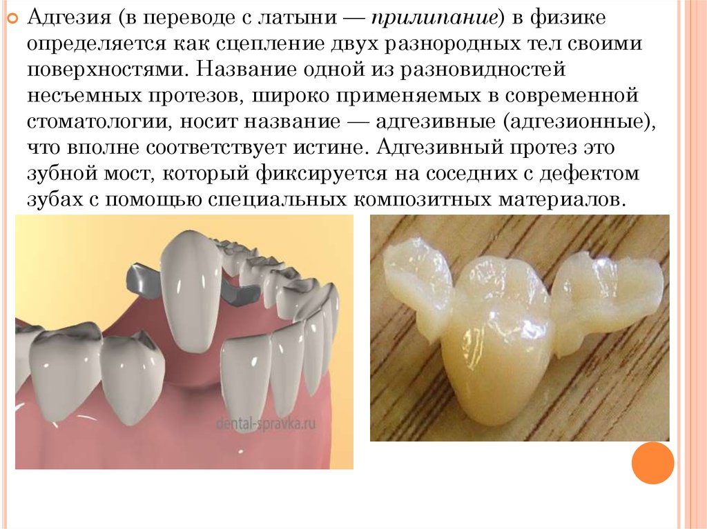 Адгезивное протезирование. Адгезивный мостовидный протез части. Понятие адгезивный мостовидный протез. Несъемный мостовидный протез состоит из. Несъемный зубной мостовидный протез состоит:.