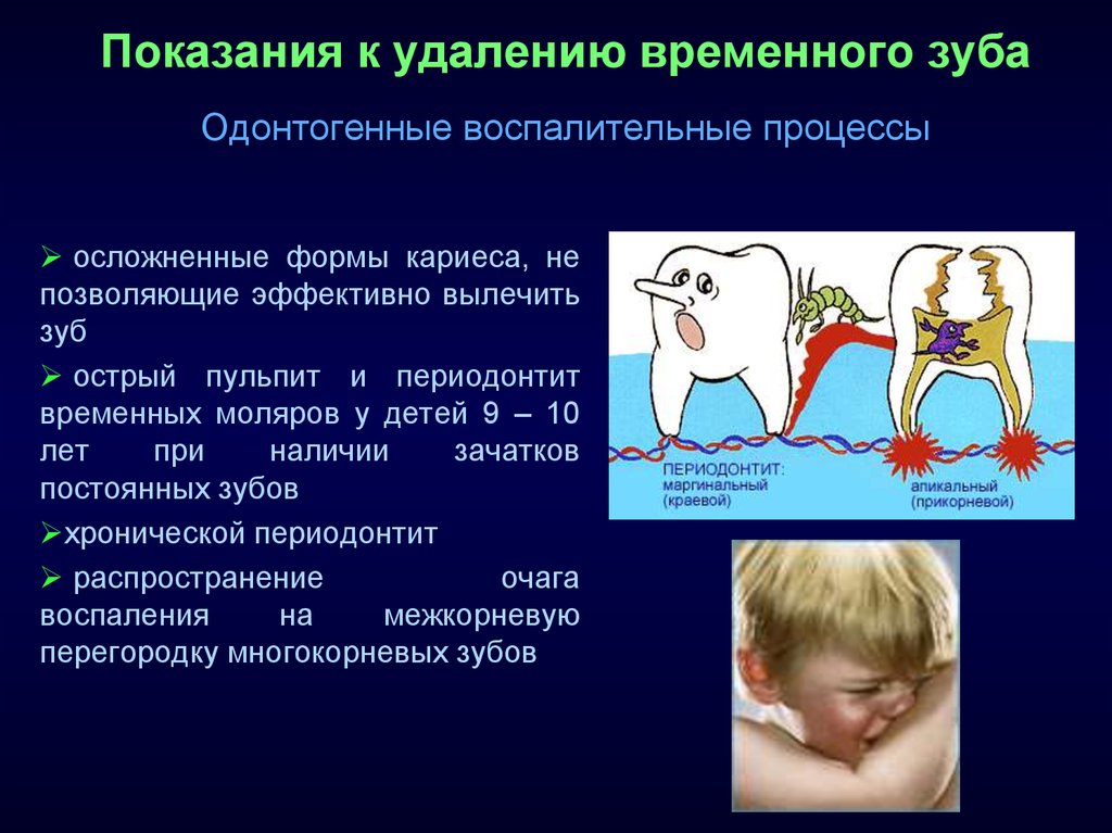 Временной зуб удаление. Показания к удалению зуба. Операция удаления зуба показания и противопоказания. Показания к удалению временных зубов у детей. Показания к удалению постоянных зубов.