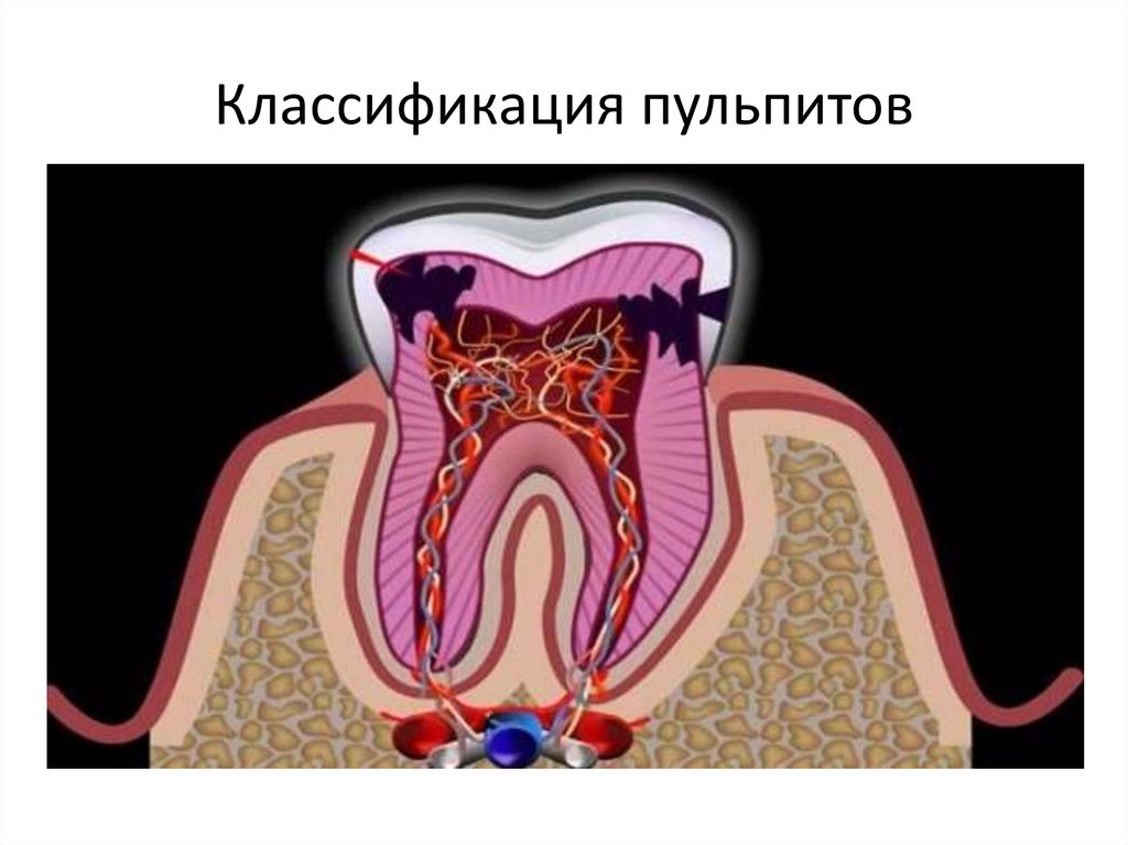 Острый диффузный пульпит. Пульпит зуба классификация. Пульпит зуба классификация острый. Хронический пульпит классификация.