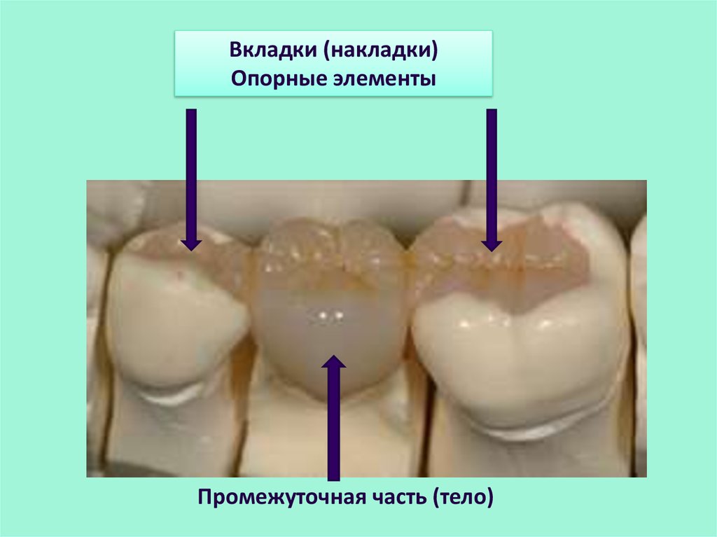 Третий вкладка. Мостовидный протез с опорой на 2 зуба. Опорные элементы мостовидных протезов. Мостовидный протез на вкладках. Мостовидные протезы с опорным элементом в виде вкладки накладки.