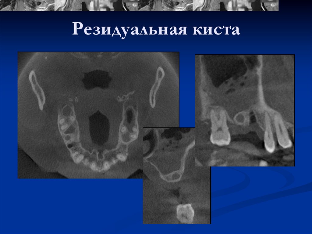 Для рентгенологической картины фолликулярной кисты характерна деструкция костной ткани