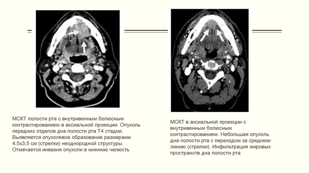 Кт ротовой полости. Образование дна полости рта кт. Болюсным контрастированием. МСКТ болюсное контрастирование. Кт с внутривенным болюсным контрастированием.