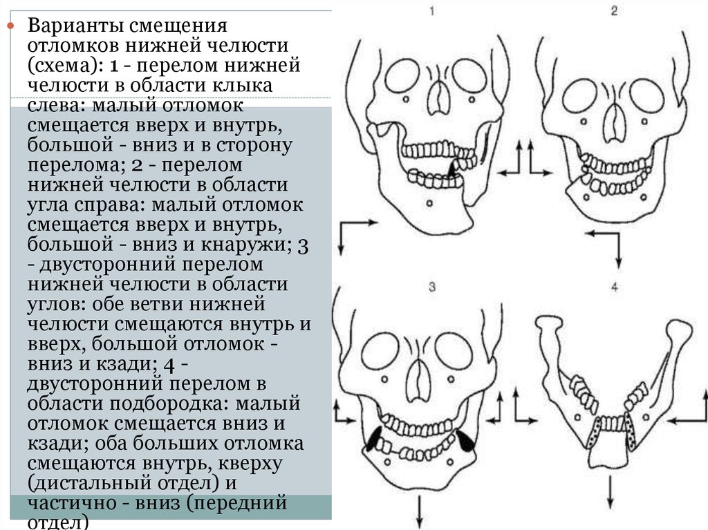 Переломы верхней и нижней челюсти презентация