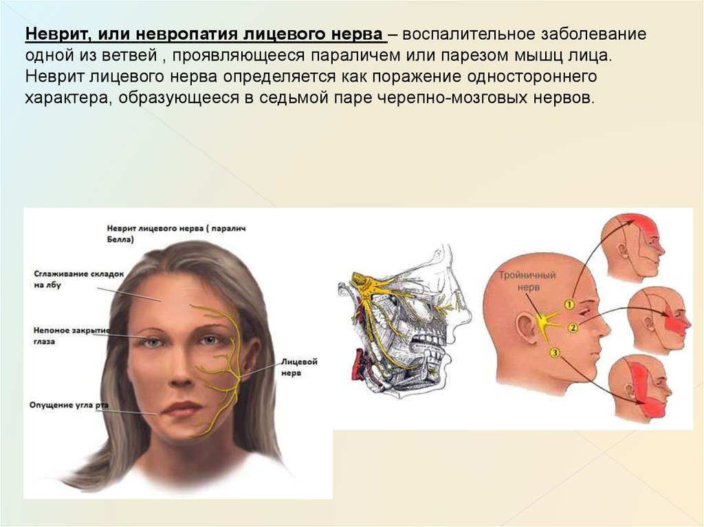 Лицевой нерв после операции. Неврит лицевого нерва. Упражнения при неврите тройничного нерва.