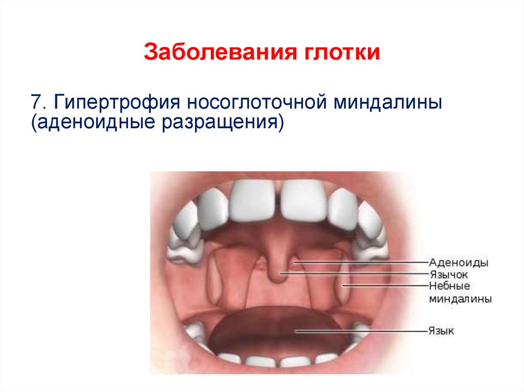 Носоглоточная миндалина. Гипертрофия небных и глоточных миндалин. Гипертрофия небных миндалин. Гиперплазия носоглоточной миндалины.