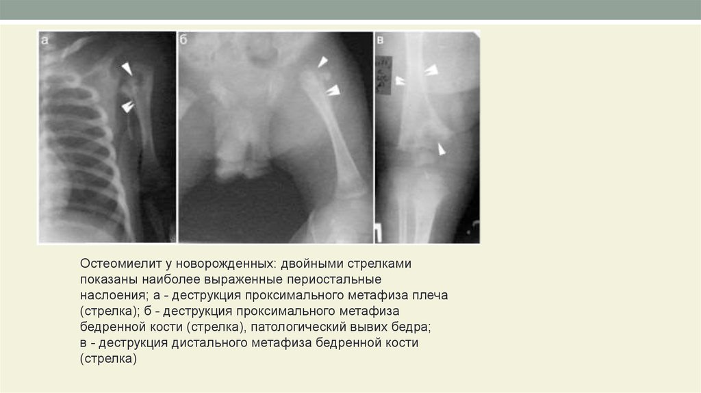 Огнестрельный остеомиелит