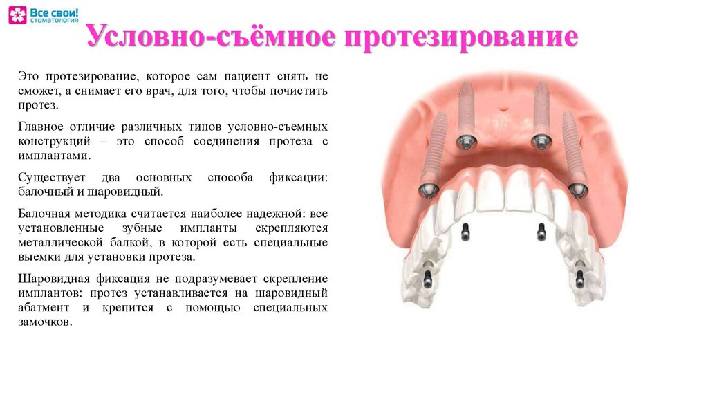 Условный протез. Съемный протез на шаровидных абатментах. Условно съёмный протез на шаровидных абатментах что это. Абатмент шаровидные протез. Крепление протеза шаровидным абатментом.