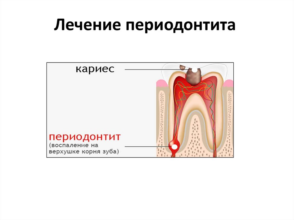 Воспаление корня зуба лечение