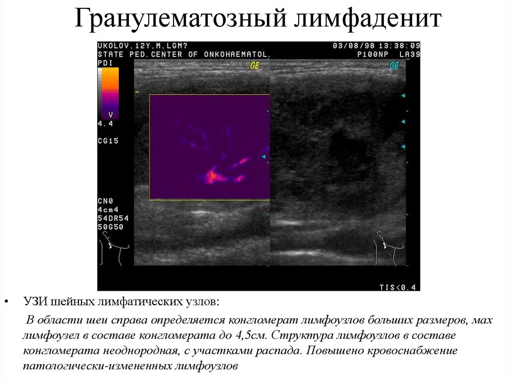Узи лимфатических. Ультразвуковая анатомия лимфоузла. Конгломерат шейных лимфоузлов УЗИ. Конгломерат лимфоузлов шеи УЗИ. Деструкция лимфатического узла УЗИ.