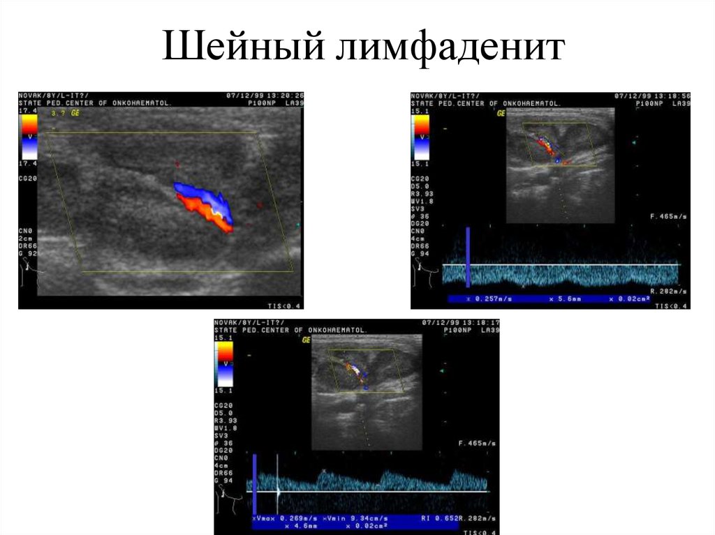 Неспецифический лимфаденит