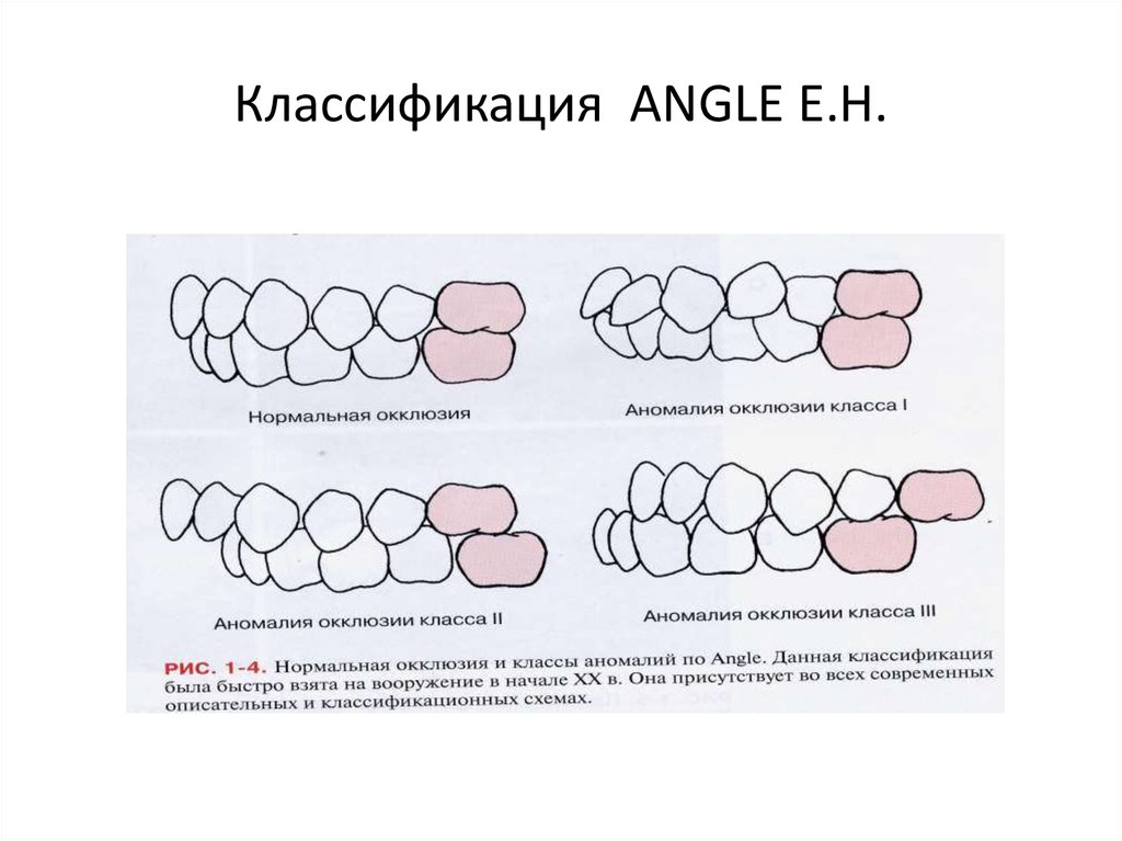 Классы окклюзии. Классификация аномалий окклюзии Персина. Классификация Энгля зубочелюстных аномалий. Классификация аномалий окклюзии по Энглю. Классификация аномалий зубных рядов Персина.