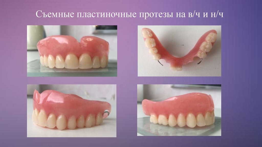 Пластиночный протез этапы. Съемный пластиночный протез. Частичный съемный пластиночный протез состоит. Съёмный пластиночный протез состоит из:. Частичный съёмный пластиногчный протез.