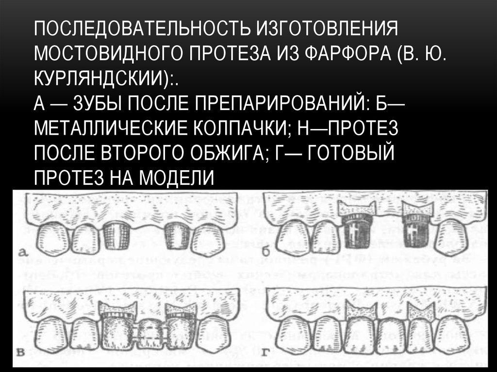 Препарирование под металлическую коронку схема